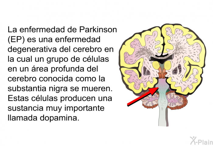 La enfermedad de Parkinson (EP) es una enfermedad degenerativa del cerebro en la cual un grupo de clulas en un rea profunda del cerebro conocida como la substantia nigra se mueren. Estas clulas producen una sustancia muy importante llamada dopamina.