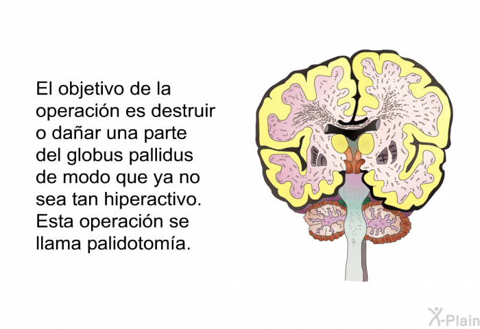 El objetivo de la operaci�n es destruir o da�ar una parte del globus pallidus de modo que ya no sea tan hiperactivo.&nbsp;Esta operaci�n se llama palidotom�a.