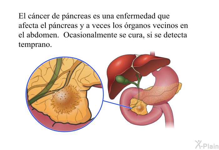 El cncer de pncreas es una enfermedad que afecta el pncreas y a veces los rganos vecinos en el abdomen. Ocasionalmente se cura, si se detecta temprano.