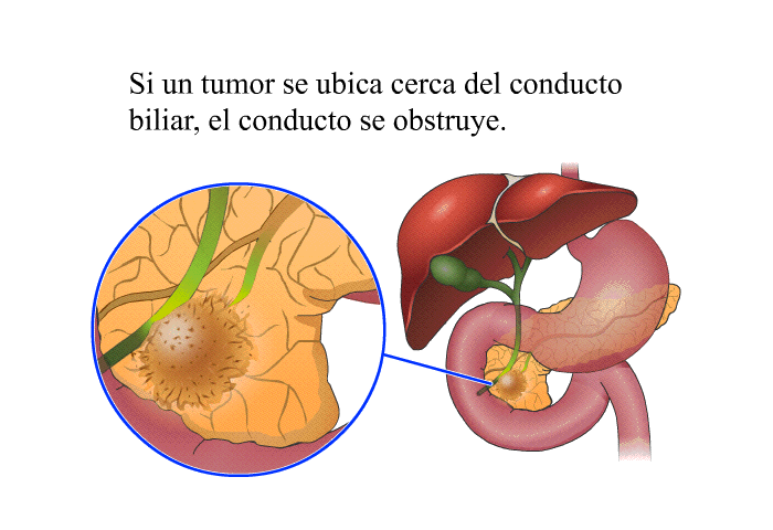 Si un tumor se ubica cerca del conducto biliar, el conducto se obstruye.