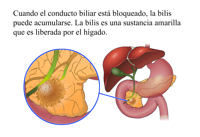 Cuando el conducto biliar est bloqueado, la bilis puede acumularse. La bilis es una sustancia amarilla que es liberada por el hgado.
