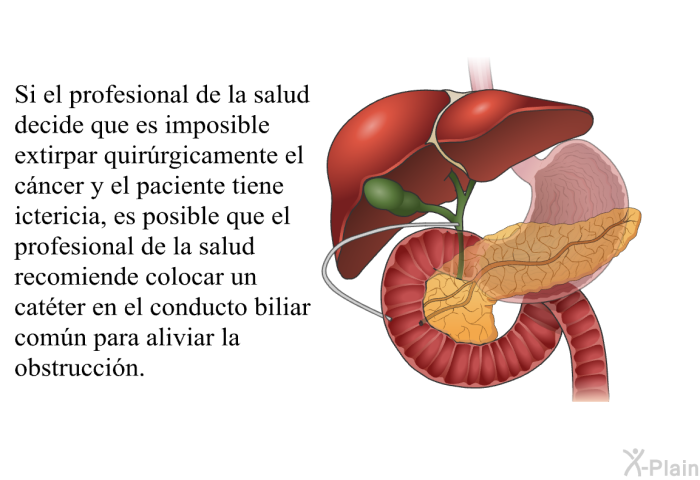 Si el profesional de la salud decide que es imposible extirpar quirrgicamente el cncer y el paciente tiene ictericia, es posible que el profesional de la salud recomiende colocar un catter en el conducto biliar comn para aliviar la obstruccin.