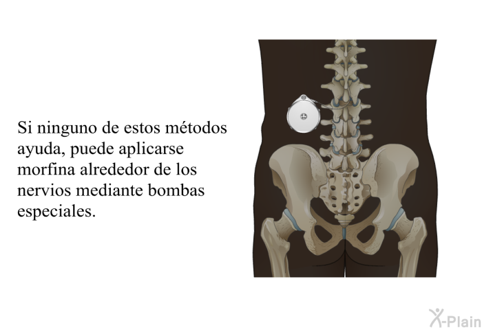 Si ninguno de estos mtodos ayuda, puede aplicarse morfina alrededor de los nervios mediante bombas especiales.