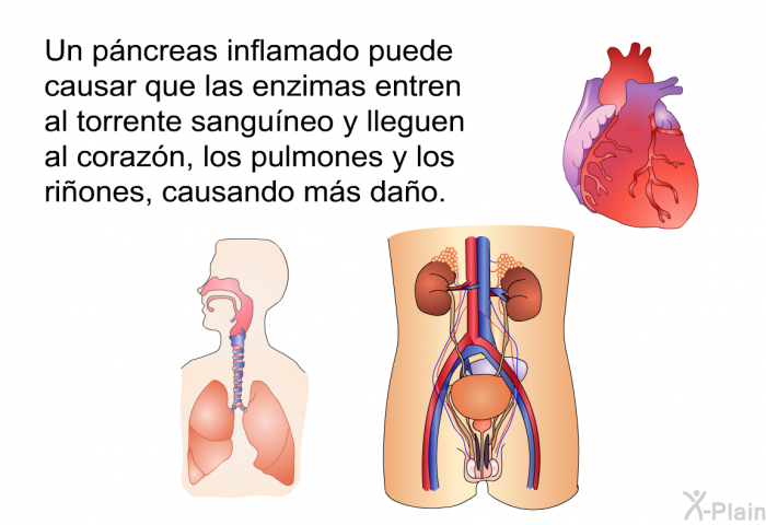 Un pncreas inflamado puede causar que las enzimas entren al torrente sanguneo y lleguen al corazn, los pulmones y los riones, causando ms dao.