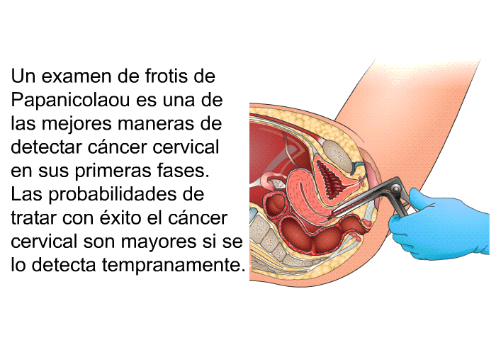 Un examen de frotis de Papanicolaou es una de las mejores maneras de detectar cncer cervical en sus primeras fases. Las probabilidades de tratar con xito el cncer cervical son mayores si se lo detecta tempranamente.