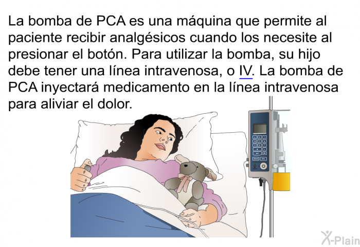 La bomba de PCA es una mquina que permite al paciente recibir analgsicos cuando los necesite al presionar el botn. Para utilizar la bomba, su hijo debe tener una lnea intravenosa, o IV. La bomba de PCA inyectar medicamento en la lnea intravenosa para aliviar el dolor.