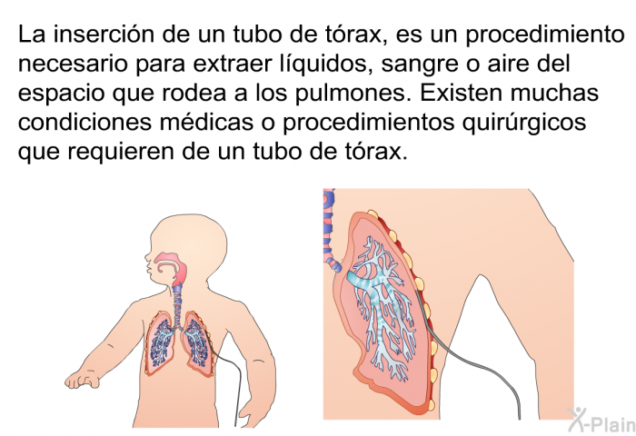 La insercin de un tubo de trax, es un procedimiento necesario para extraer lquidos, sangre o aire del espacio que rodea a los pulmones. Existen muchas condiciones mdicas o procedimientos quirrgicos que requieren de un tubo de trax.