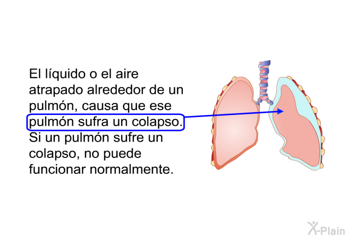 El lquido o el aire atrapado alrededor de un pulmn, causa que ese pulmn sufra un colapso. Si un pulmn sufre un colapso, no puede funcionar normalmente.