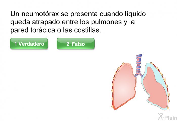 Un neumotrax se presenta cuando lquido queda atrapado entre los pulmones y la pared torcica o las costillas. Presione Verdadero o Falso.