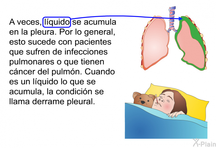 A veces, lquido se acumula en la pleura. Por lo general, esto sucede con pacientes que sufren de infecciones pulmonares o que tienen cncer del pulmn. Cuando es un lquido lo que se acumula, la condicin se llama derrame pleural.