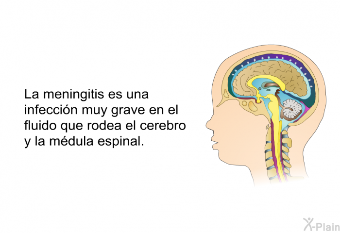 La meningitis es una infeccin muy grave en el fluido que rodea el cerebro y la mdula espinal.