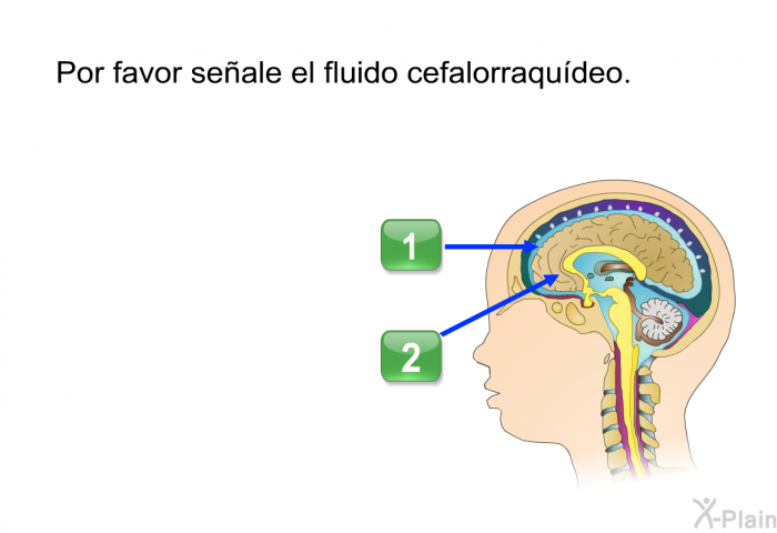 Por favor seale el fluido cefalorraqudeo.