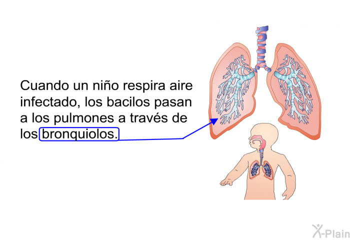 Cuando un nio respira aire infectado, los bacilos pasan a los pulmones a travs de los bronquiolos.