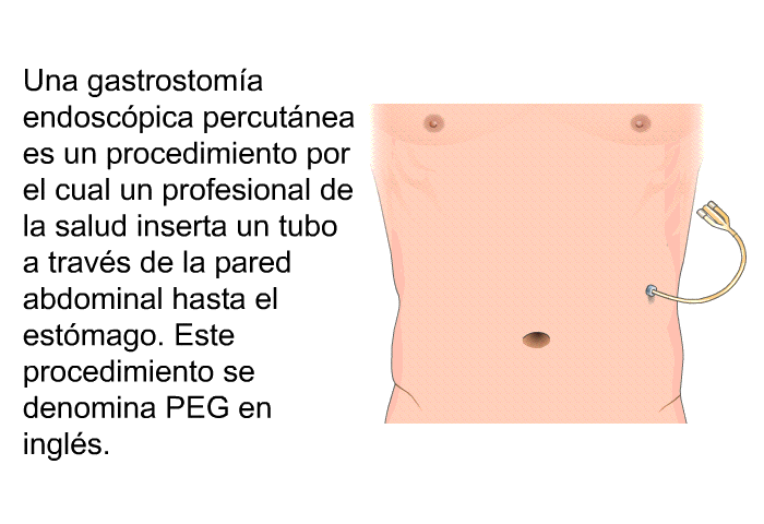 Una gastrostoma endoscpica percutnea es un procedimiento por el cual un profesional de la salud inserta un tubo a travs de la pared abdominal hasta el estmago. Este procedimiento se denomina PEG en ingls.