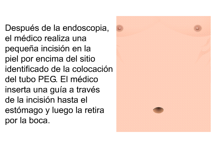 Despus de la endoscopia, el mdico realiza una pequea incisin en la piel por encima del sitio identificado de la colocacin del tubo PEG. El mdico inserta una gua a travs de la incisin hasta el estmago y luego la retira por la boca.