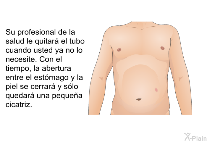 Su profesional de la salud le quitar el tubo cuando usted ya no lo necesite. Con el tiempo, la abertura entre el estmago y la piel se cerrar y slo quedar una pequea cicatriz.