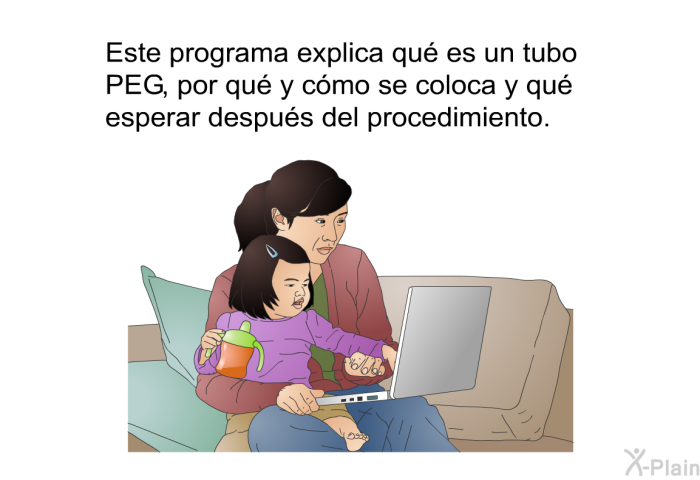 Esta informacin acerca de su salud explica qu es un tubo PEG, por qu y cmo se coloca y qu esperar despus del procedimiento.