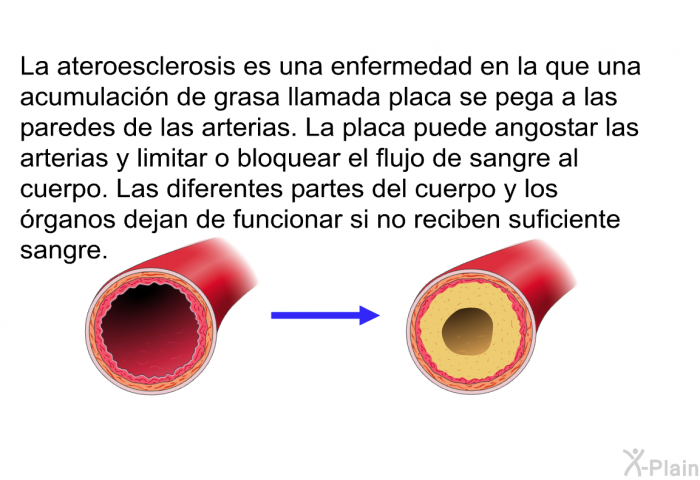 La ateroesclerosis es una enfermedad en la que una acumulacin de grasa llamada placa se pega a las paredes de las arterias. La placa puede angostar las arterias y limitar o bloquear el flujo de sangre al cuerpo. Las diferentes partes del cuerpo y los rganos dejan de funcionar si no reciben suficiente sangre.