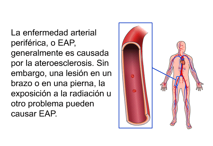 La enfermedad arterial perifrica, o EAP, generalmente es causada por la ateroesclerosis. Sin embargo, una lesin en un brazo o en una pierna, la exposicin a la radiacin u otro problema pueden causar EAP.
