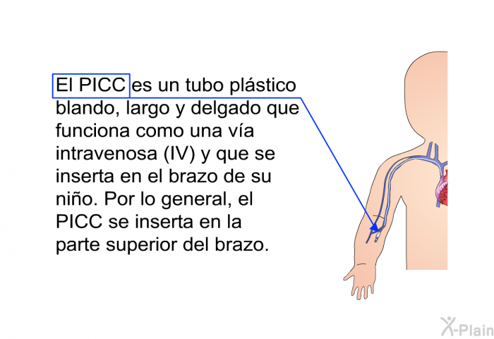 El PICC es un tubo plstico blando, largo y delgado que funciona como una va intravenosa (IV) y que se inserta en el brazo de su nio. Por lo general, el PICC se inserta en la parte superior del brazo.