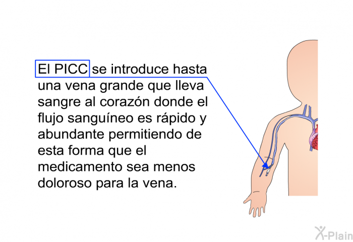 El PICC se introduce hasta una vena grande que lleva sangre al corazn donde el flujo sanguneo es rpido y abundante permitiendo de esta forma que el medicamento sea menos doloroso para la vena.