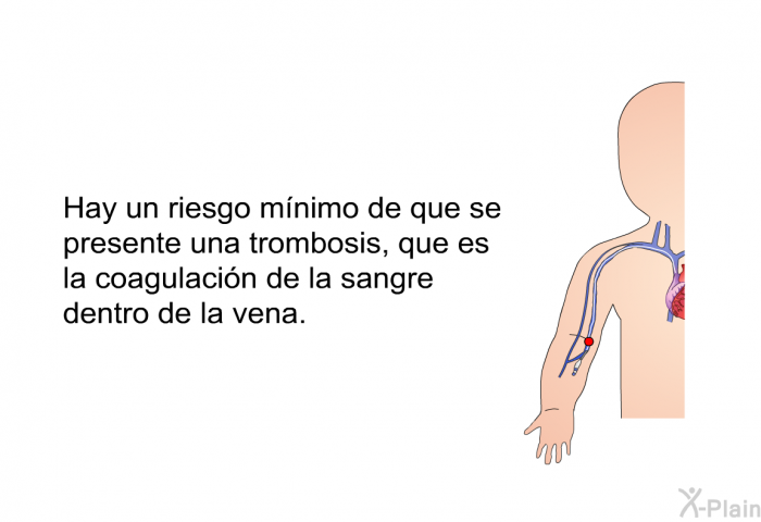 Hay un riesgo m�nimo de que se presente una trombosis, que es la coagulaci�n de la sangre dentro de la vena.