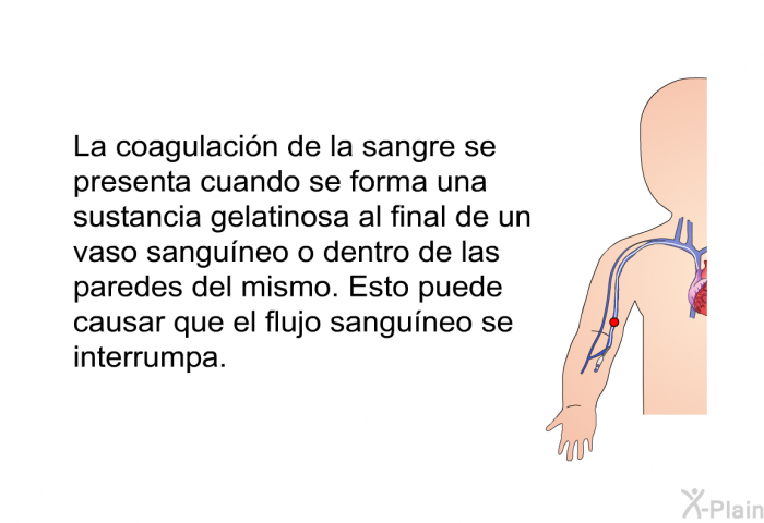 La coagulaci�n de la sangre se presenta cuando se forma una sustancia gelatinosa al final de un vaso sangu�neo o dentro de las paredes del mismo. Esto puede causar que el flujo sangu�neo se interrumpa.
