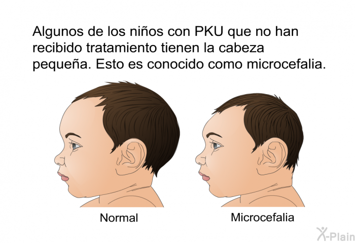 Algunos de los nios con PKU que no han recibido tratamiento tienen la cabeza pequea. Esto es conocido como microcefalia.