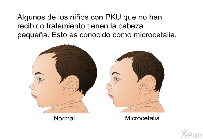 Algunos de los nios con PKU que no han recibido tratamiento tienen la cabeza pequea. Esto es conocido como microcefalia.