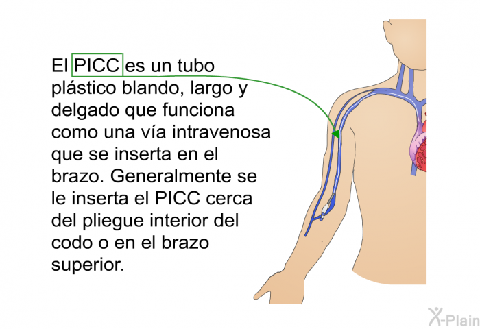 El PICC es un tubo plstico blando, largo y delgado que funciona como una va intravenosa que se inserta en el brazo. Generalmente se le inserta el PICC cerca del pliegue interior del codo o en el brazo superior.