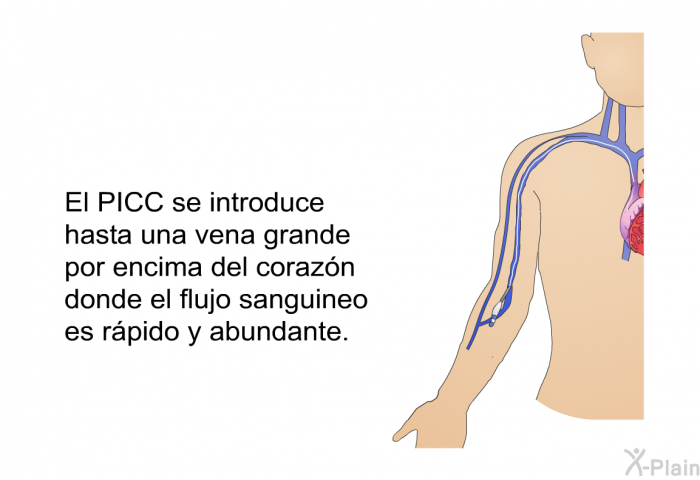 El PICC se introduce hasta una vena grande por encima del corazn donde el flujo sanguineo es rpido y abundante.
