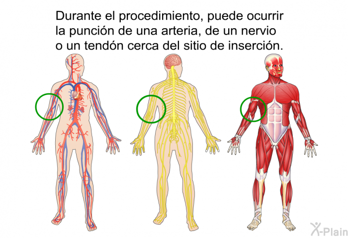 Durante el procedimiento, puede ocurrir la punci�n de una arteria, de un nervio o un tend�n cerca del sitio de inserci�n.