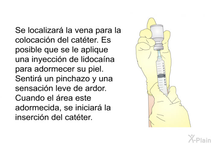 Se localizar la vena para la colocacin del catter. Es posible que se le aplique una inyeccin de lidocana para adormecer su piel. Sentir un pinchazo y una sensacin leve de ardor. Cuando el rea este adormecida, se iniciar la insercin del catter.