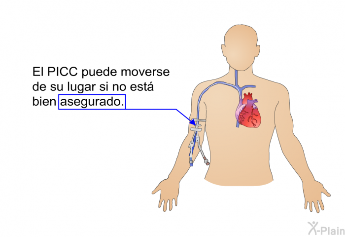 El PICC puede moverse de su lugar si no est bien asegurado.