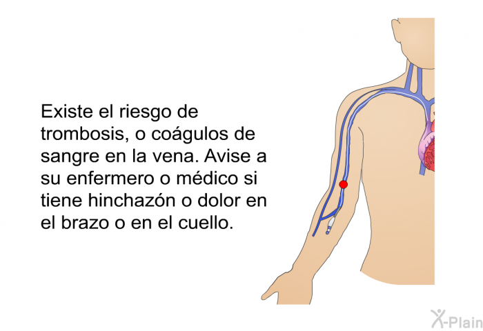 Existe el riesgo de trombosis, o cogulos de sangre en la vena. Avise a su enfermero o mdico si tiene hinchazn o dolor en el brazo o en el cuello.