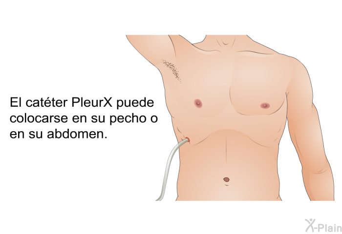 El catter PleurX puede colocarse en su pecho o en su abdomen.