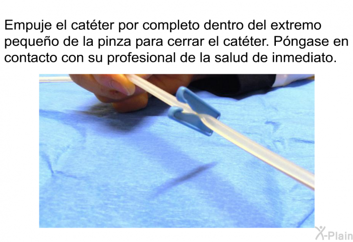 Empuje el catter por completo dentro del extremo pequeo de la pinza para cerrar el catter. Pngase en contacto con su profesional de la salud de inmediato.