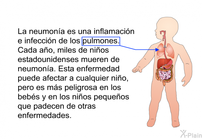 La neumona es una inflamacin e infeccin de los pulmones. Cada ao, miles de nios estadounidenses mueren de neumona. Esta enfermedad puede afectar a cualquier nio, pero es ms peligrosa en los bebs y en los nios pequeos que padecen de otras enfermedades.