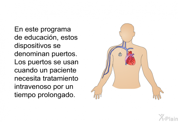 En esta informacin acerca de su salud, estos dispositivos se denominan puertos. Los puertos se usan cuando un paciente necesita tratamiento intravenoso por un tiempo prolongado.