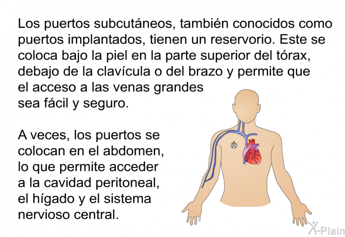 Los puertos subcutneos, tambin conocidos como puertos implantados, tienen un reservorio. Este se coloca bajo la piel en la parte superior del trax, debajo de la clavcula o del brazo y permite que el acceso a las venas grandes sea fcil y seguro. 
 A veces, los puertos se colocan en el abdomen, lo que permite acceder a la cavidad peritoneal, el hgado y el sistema nervioso central.