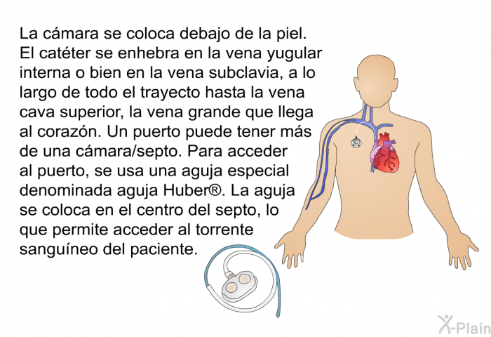 La cmara se coloca debajo de la piel. El catter se enhebra en la vena yugular interna o bien en la vena subclavia, a lo largo de todo el trayecto hasta la vena cava superior, la vena grande que llega al corazn. Un puerto puede tener ms de una cmara/septo. Para acceder al puerto, se usa una aguja especial denominada aguja Huber. La aguja se coloca en el centro del septo, lo que permite acceder al torrente sanguneo del paciente.