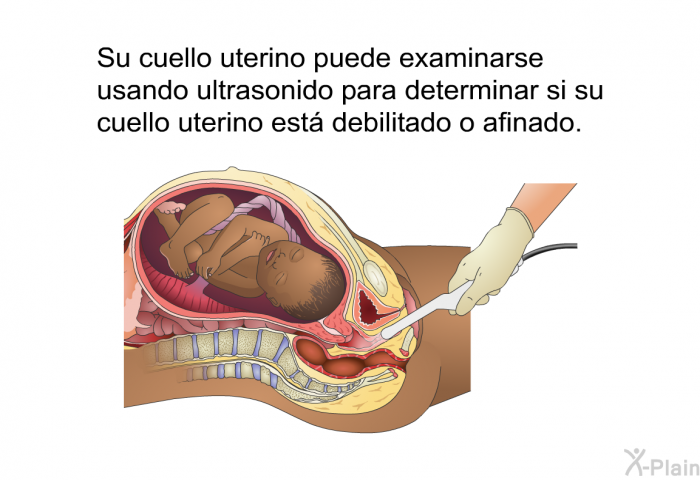 Su cuello uterino puede examinarse usando ultrasonido para determinar si su cuello uterino est debilitado o afinado.