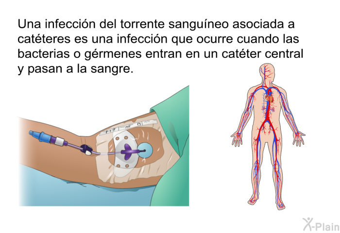 Una infeccin del torrente sanguneo asociada a catteres es una infeccin que ocurre cuando las bacterias o grmenes entran en un catter central y pasan a la sangre.