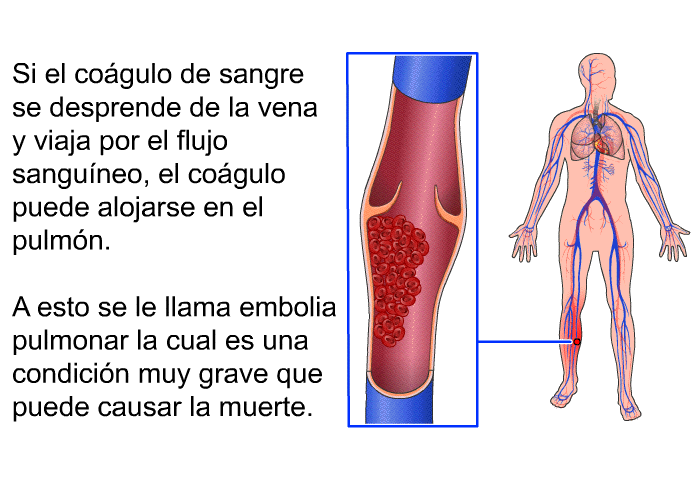 Si el cogulo de sangre se desprende de la vena y viaja por el flujo sanguneo, el cogulo puede alojarse en el pulmn. A esto se le llama embolia pulmonar la cual es una condicin muy grave que puede causar la muerte.