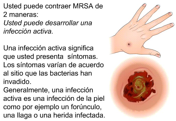 Usted puede contraer MRSA de 2 maneras:<B> Usted puede desarrollar una infeccin activa. </B>
Una infeccin activa significa que usted presenta sntomas. Los sntomas varan de acuerdo al sitio que las bacterias han invadido. Generalmente, una infeccin activa es una infeccin de la piel como por ejemplo un fornculo, una llaga o una herida infectada.