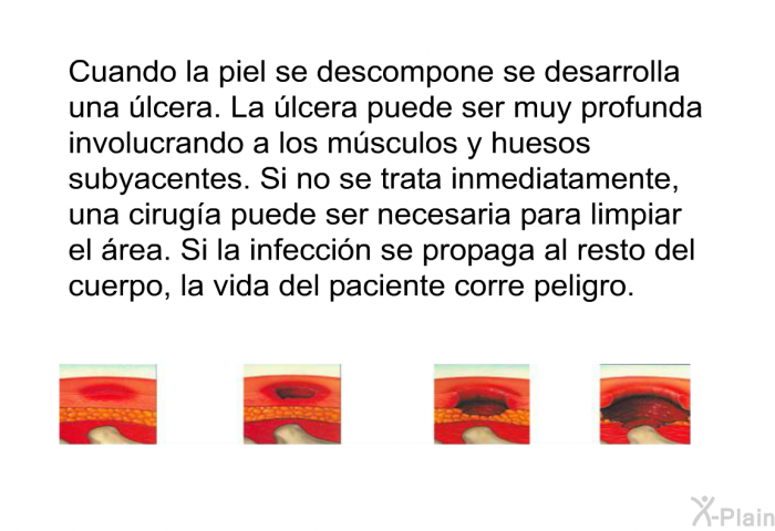 Cuando la piel se descompone se desarrolla una lcera. La lcera puede ser muy profunda involucrando a los msculos y huesos subyacentes. Si no se trata inmediatamente, una ciruga puede ser necesaria para limpiar el rea. Si la infeccin se propaga al resto del cuerpo, la vida del paciente corre peligro.