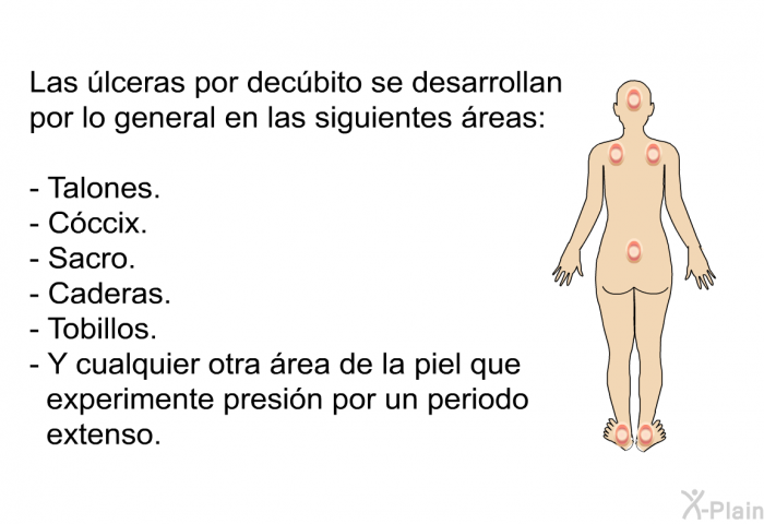 Las lceras por decbito se desarrollan por lo general en las siguientes reas:  Talones. Cccix. Sacro. Caderas. Tobillos. Y cualquier otra rea de la piel que experimente presin por un periodo extenso.