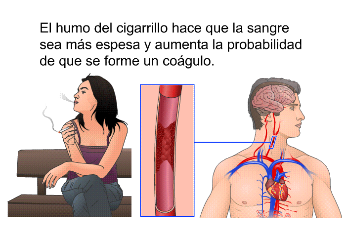 El humo del cigarrillo hace que la sangre sea m�s espesa y aumenta la probabilidad de que se forme un co�gulo.
