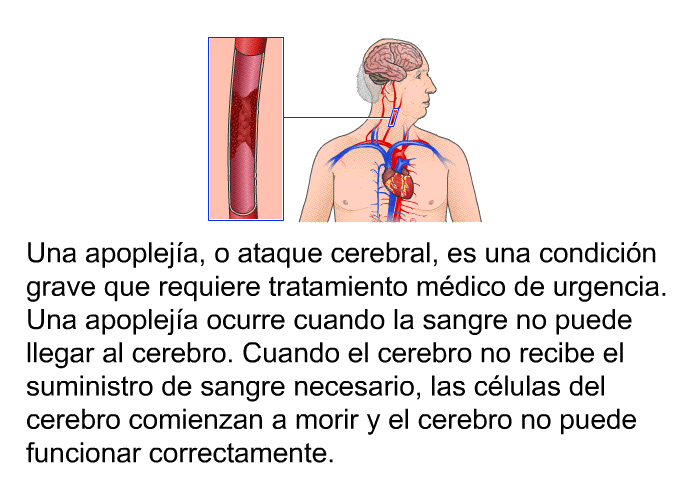 Una apopleja, o ataque cerebral, es una condicin grave que requiere tratamiento mdico de urgencia. Una apopleja ocurre cuando la sangre no puede llegar al cerebro. Cuando el cerebro no recibe el suministro de sangre necesario, las clulas del cerebro comienzan a morir y el cerebro no puede funcionar correctamente.