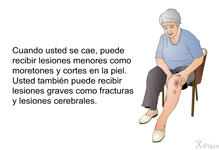 Cuando usted se cae, puede recibir lesiones menores como moretones y cortes en la piel. Usted tambin puede recibir lesiones graves como fracturas y lesiones cerebrales.